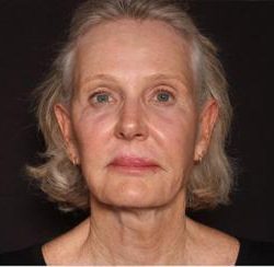 Sofwave Before & After Patient #1598